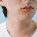 Impetigo u dětí: jak ho poznat, jak se léčí a proč se tak rychle šíří