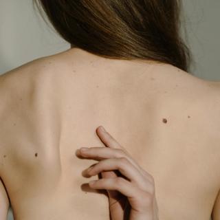 Melanom: příznaky, prevence a příspěvky pojišťoven
