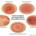 lyme-disease-bullseye-rash.jpg